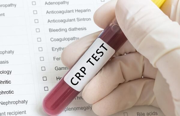 CRP (C-Reactive Protein)